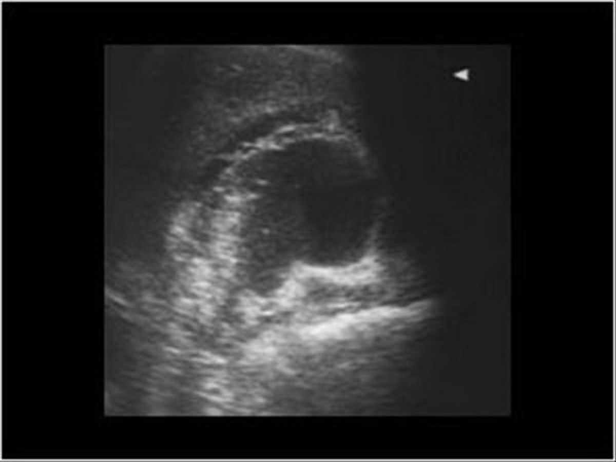 Membranous and gangrenous cholecystitis sample