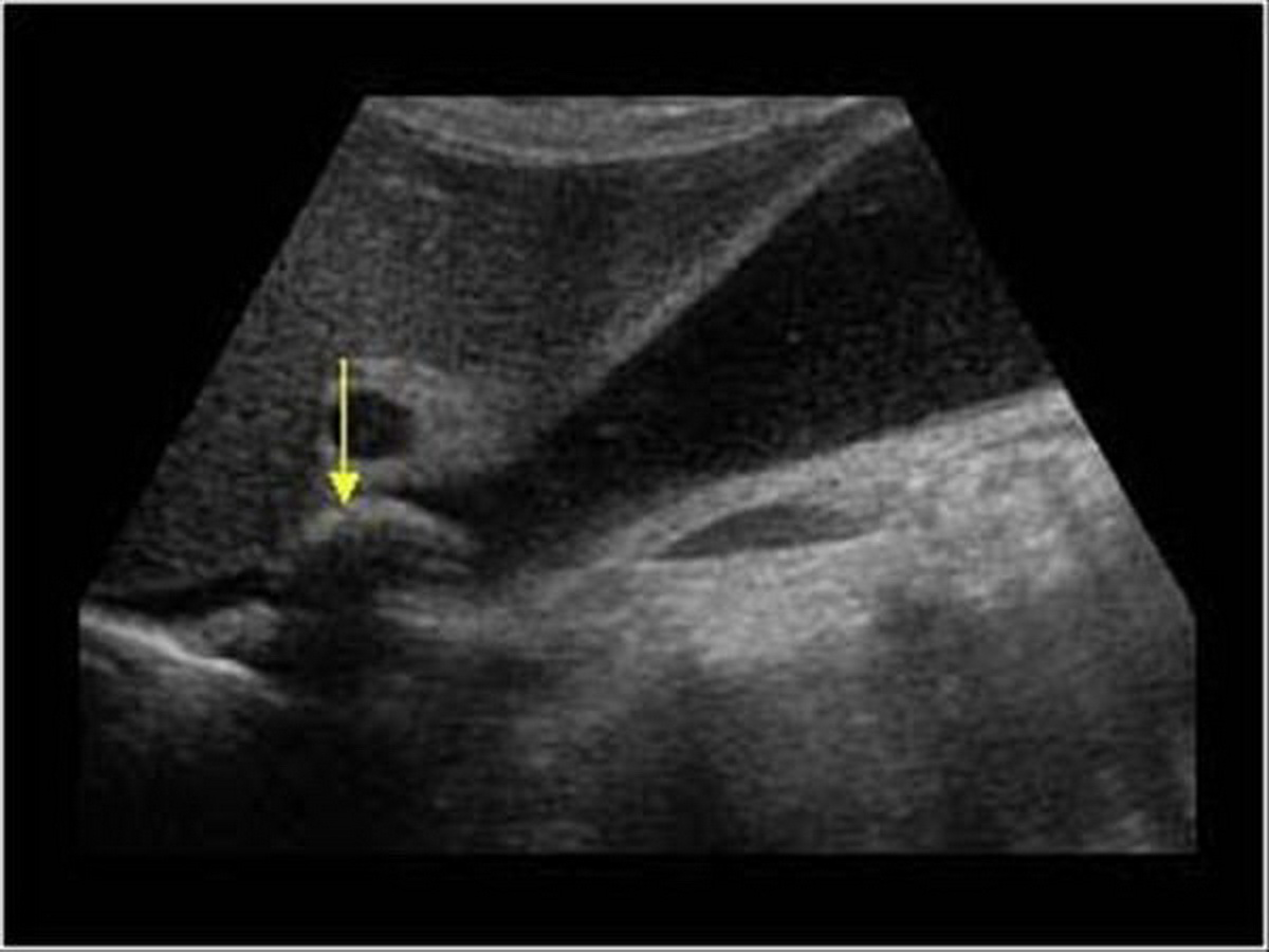 Cholecystitis sample